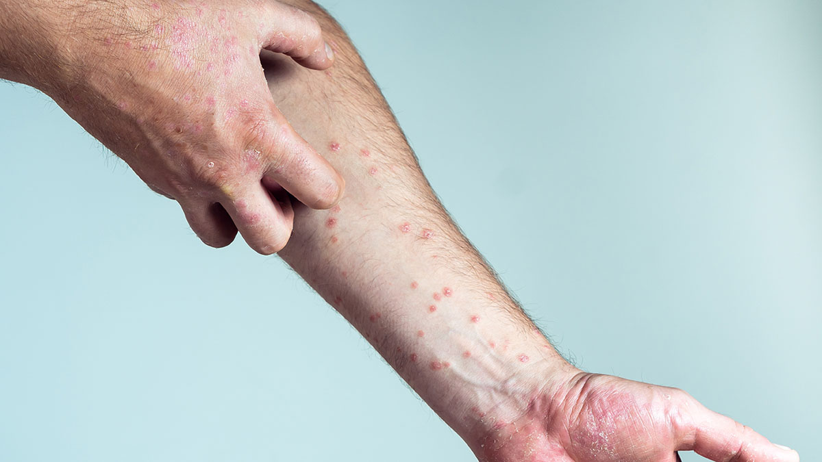 Illness psoriasis